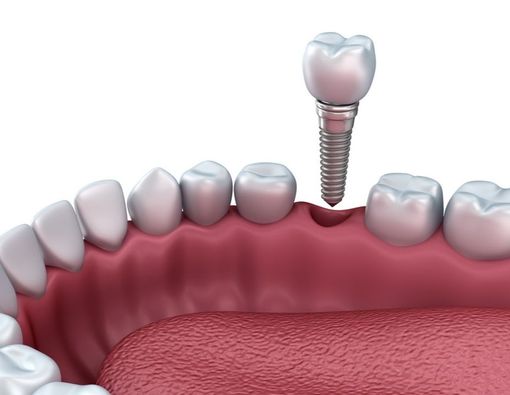 Implan di Bidang Kedokteran Gigi