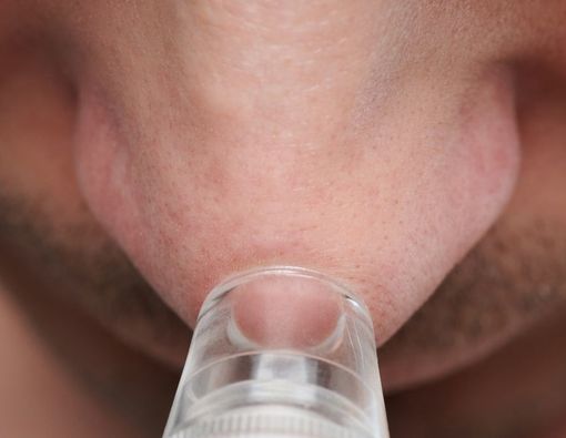 Pakai Alat Vacum Komedo Efektif atau Bahaya?