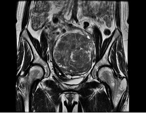 Mengatasi Mioma Uteri dengan Obat Herbal, Efektifkah?