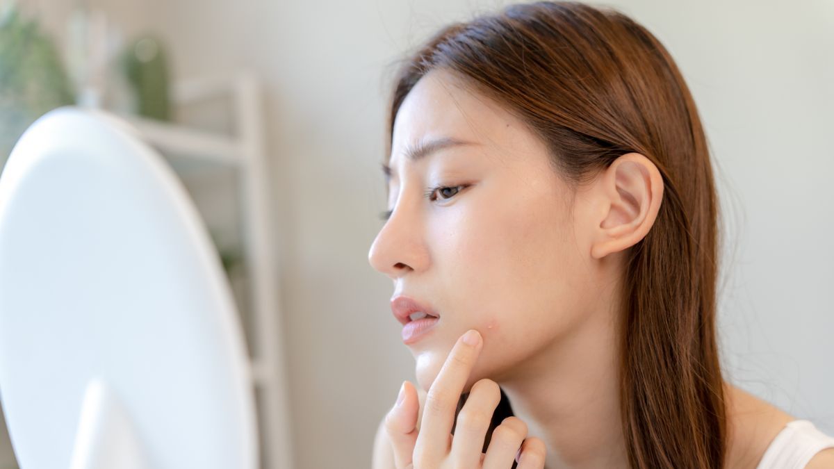 cara menghilangkan bekas jerawat