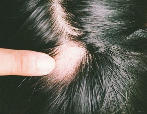 Penyebab Rambut Rontok Pada Penderita Diabetes