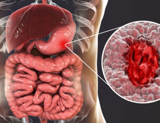 Puasa Bisa Sembuhkan Mag, Ini Fakta Medisnya