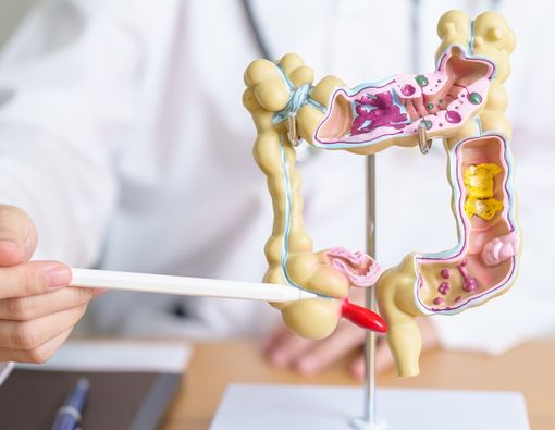 Mengenal Kanker Kolorektal dan Apakah Bisa Sembuh?