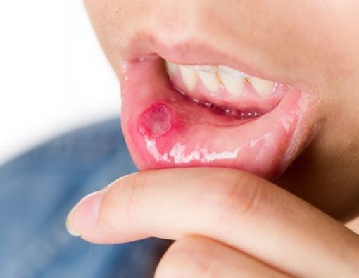 Ini yang Dapat Terjadi Pada Mulut &amp; Gigi Anda Ketika Terkena AIDS