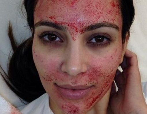 Benarkah Facial Vampir seperti Kim Kardashian Bisa Tularkan HIV?