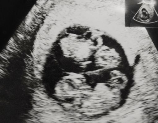 Penyebab Terjadinya Hidden Twins dan Pengaruhnya pada Janin