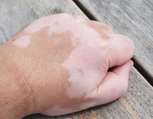 4 Penyebab Bercak Putih pada Kulit Anak