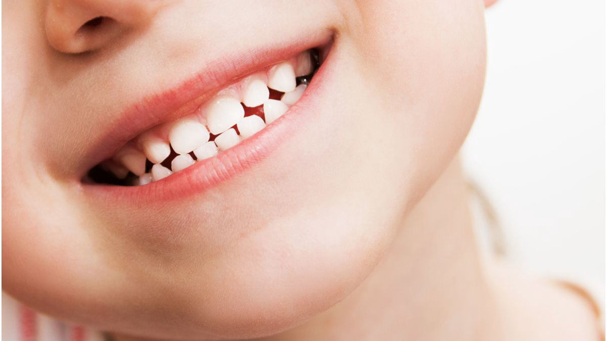 Tips Merawat Gigi Susu Anak