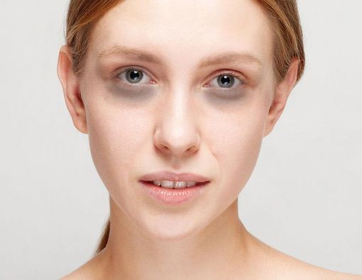 Mata Panda, Jangan- Jangan Kurang Darah?