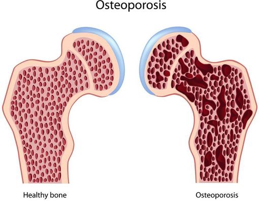 Bisakah Osteoporosis Disembuhkan?