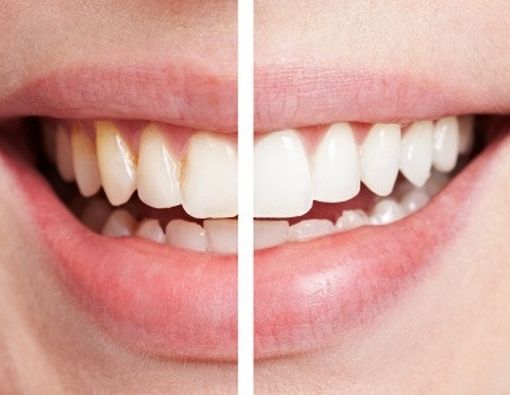 Plak dan Karang Gigi