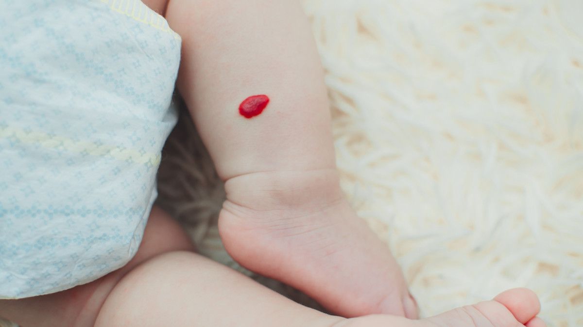 Hemangioma, Benjolan Merah pada Kulit Bayi, Berbahayakah?