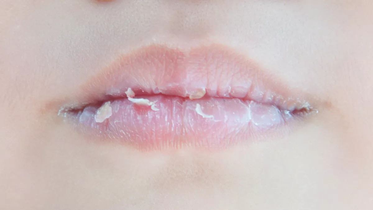 5 Kebiasaan yang Bikin Bibir Pecah-pecah Makin Memburuk
