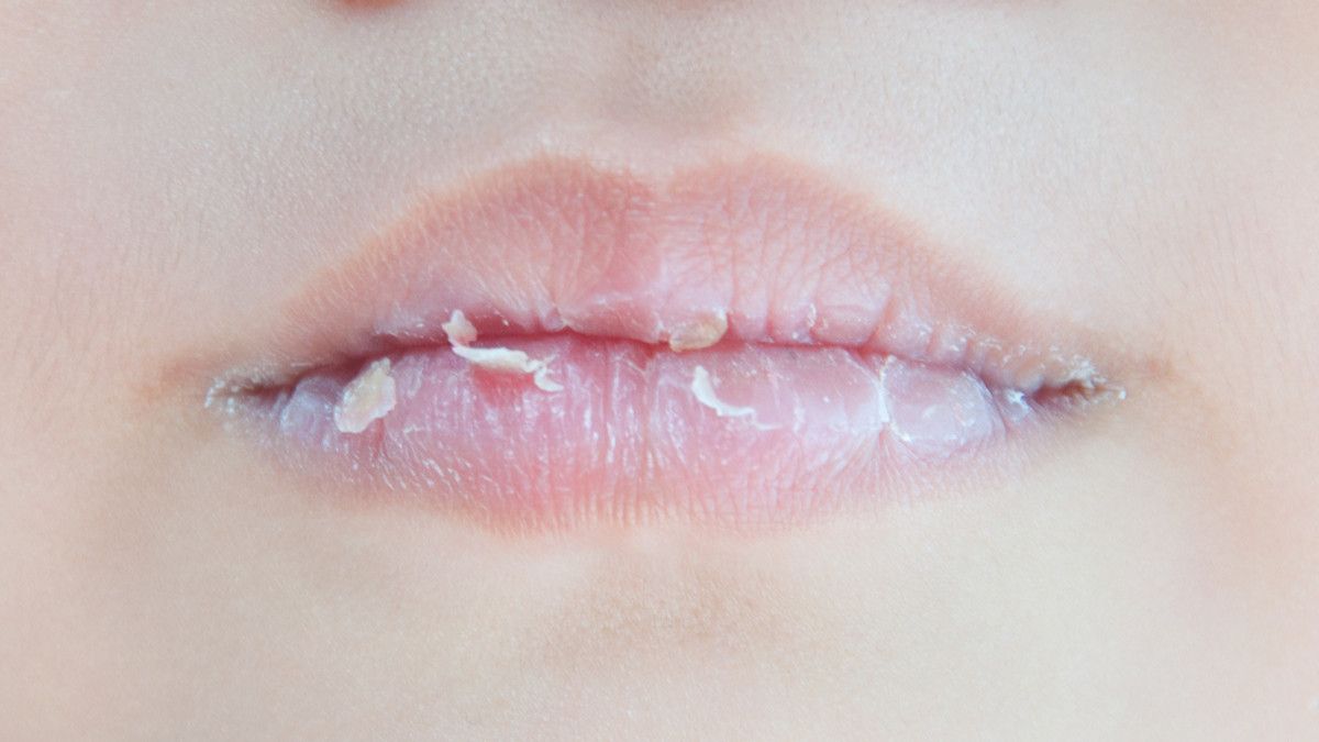 5 Kebiasaan yang Bikin Bibir Pecah-pecah Makin Memburuk