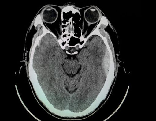 Kenali Kondisi Cedera Kepala Epidural Hematoma