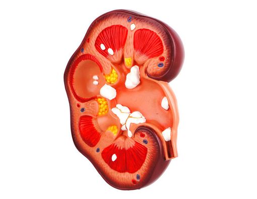 Benarkah Batu Ginjal Picu Infeksi Saluran Kemih?