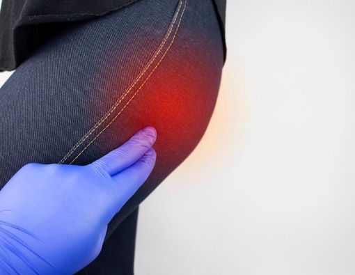 Pantat Kesemutan dan Mati Rasa, Awas Piriformis Syndrome!