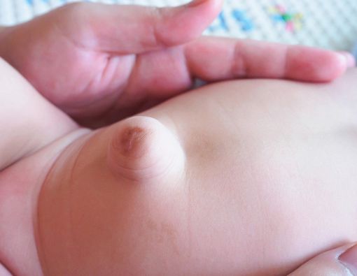 Hernia Umbilikalis