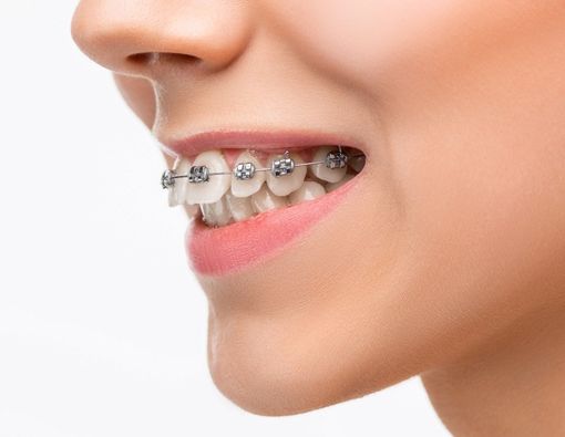 Pentingnya Kontrol Behel Rutin Saat Pandemi COVID-19