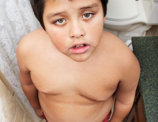 Tips Obesitas pada Anak