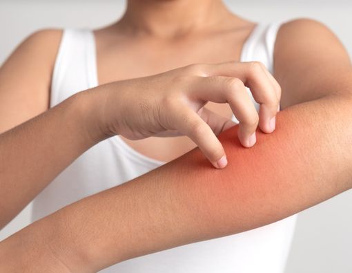 Mengungkap Efektivitas Vitamin D untuk Atasi Kulit Gatal