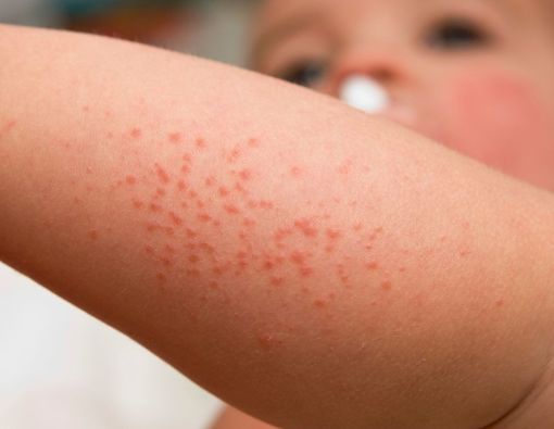 Gejala Henoch-Schonlein Purpura pada Anak