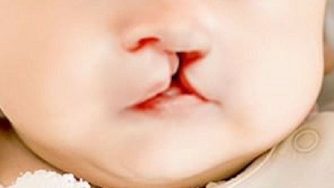 Masalah Kesehatan yang Bisa Timbul Akibat Bibir Sumbing