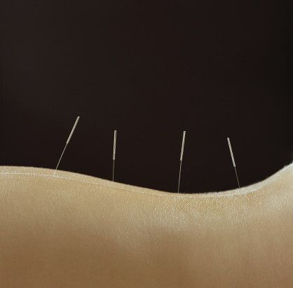Atasi Ketakutan Terhadap Perawatan Gigi dengan Terapi Akupunktur