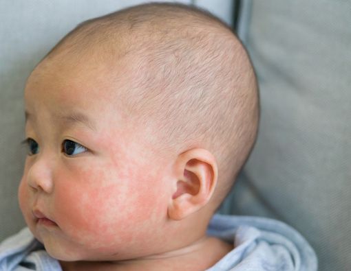 Eksim Susu pada Bayi, Kondisi Apakah Itu?