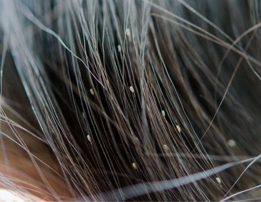 Tanda Kutu Rambut yang Tak Boleh Diabaikan