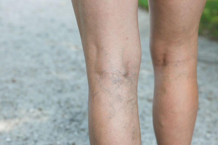 Deep Vein Thrombosis