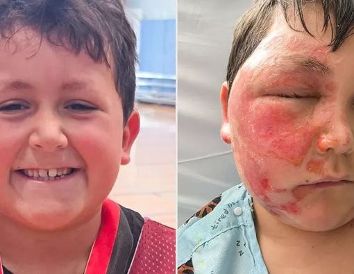 Akibat Ugal-Ugalan dalam Mengikuti Trends Media Sosial Anak 9 Tahun Mengalami Luka Bakar