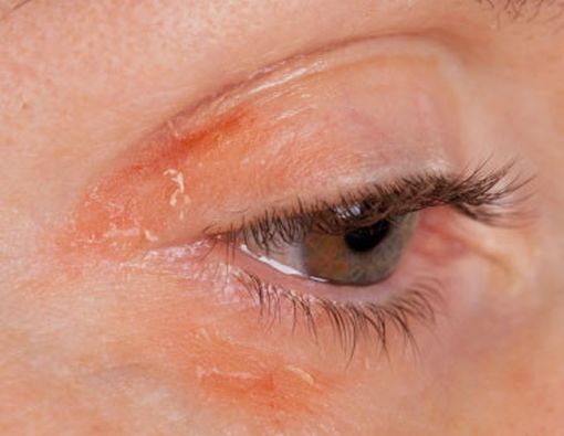 Merokok Terkait Dengan Risiko Psoriasis Lebih Tinggi