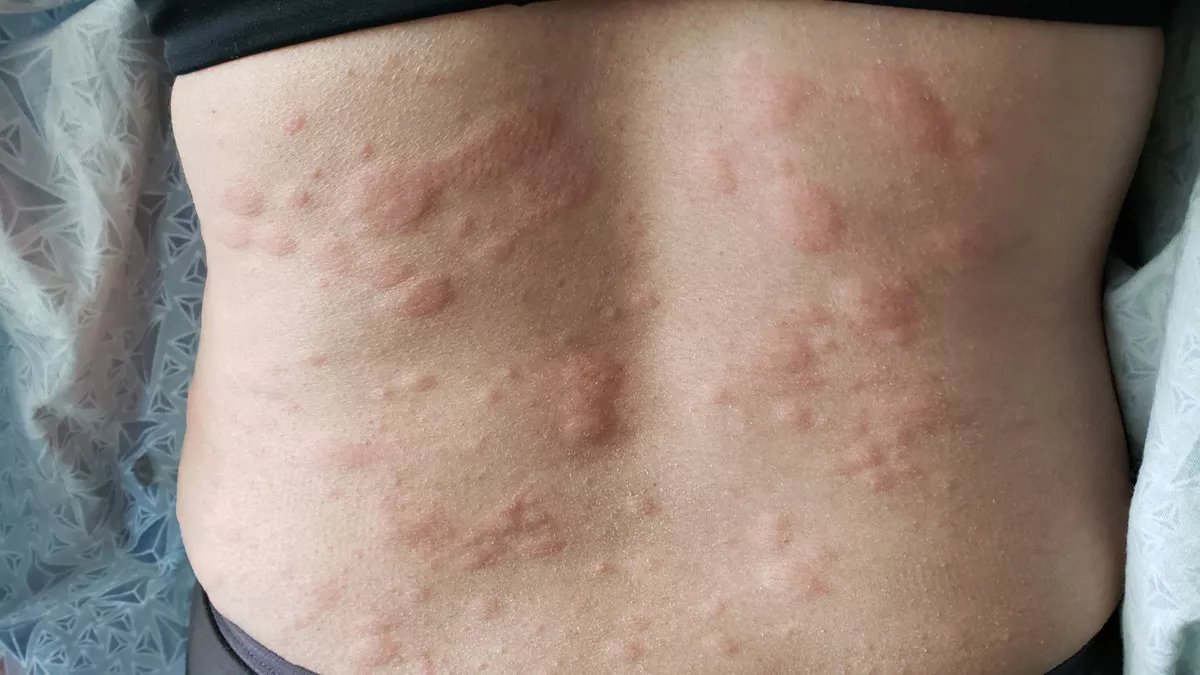 12 Cara Mengatasi Biduran Alami dan Tanpa Obat