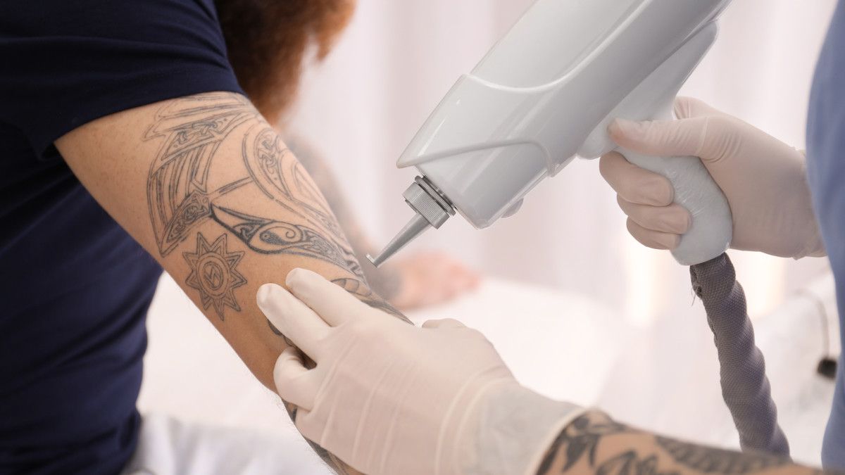 Mau Menghapus Tato secara Permanen? Ini yang Harus Diperhatikan
