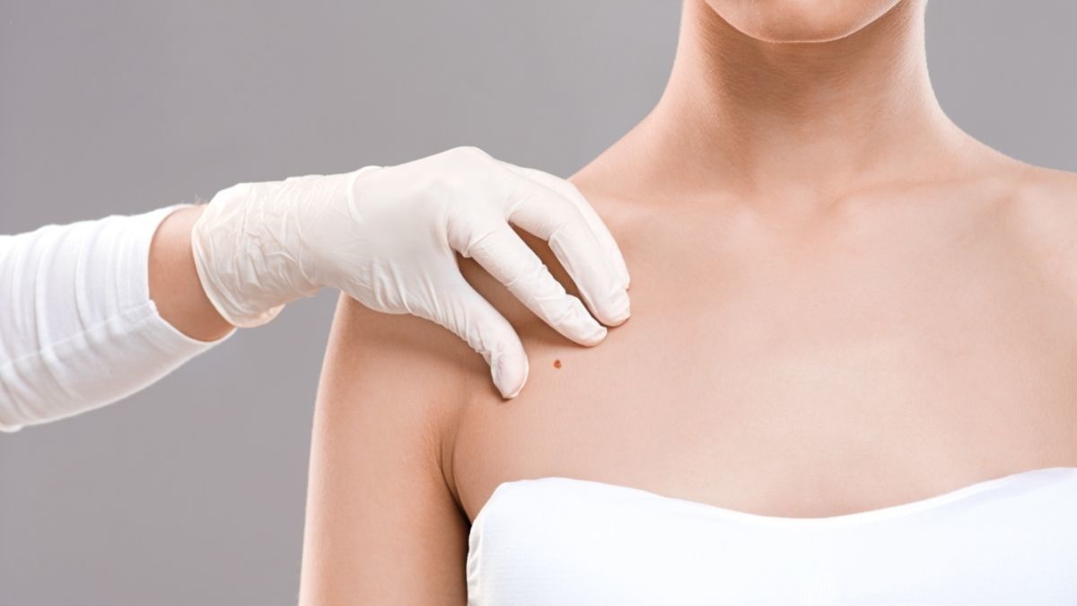 Waspada, Tahi Lalat Bisa Jadi Gejala Kanker Payudara