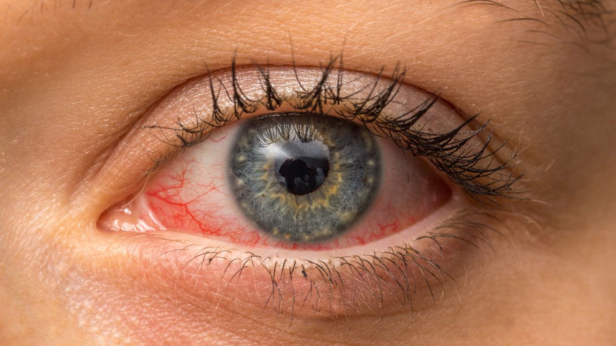 5 Penyebab Mata Merah yang Paling Sering