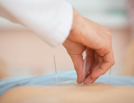 Terapi Akupunktur Untuk PCOS, Efektifkah?