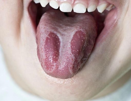 Ciri-Ciri Lidah Berjamur yang Harus Kamu Waspadai 