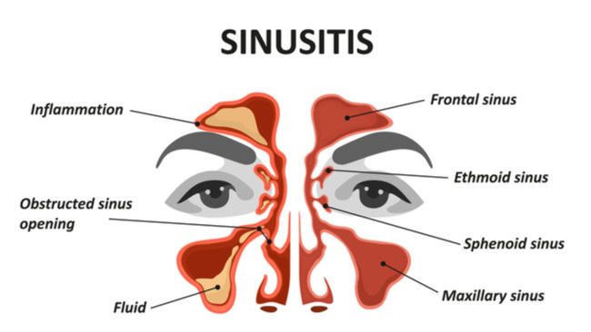 Tanda Kamu Mengalami Sinusitis