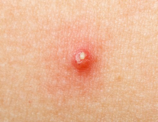 Apa Perbedaan Jerawat dan Bisul?