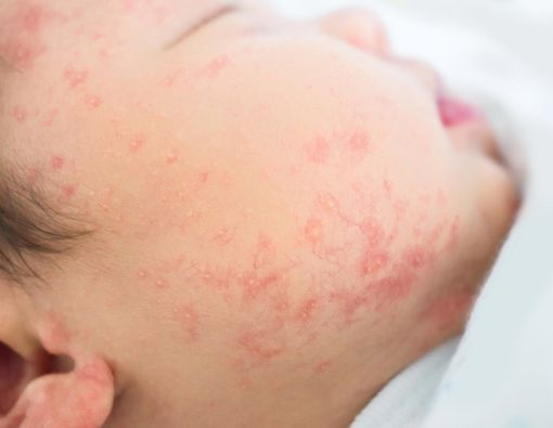 Ruam Merah pada Bayi, Apakah Tanda Alergi?