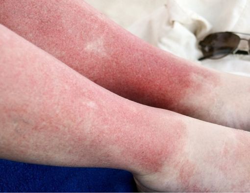 Berbagai Kondisi yang Bisa Menyebabkan Kulit Belang