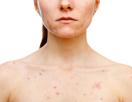 Waspada, Ini Penyebab Bisul pada Penderita Diabetes