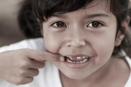 Gigi Si Kecil Patah, Harus Bagaimana?