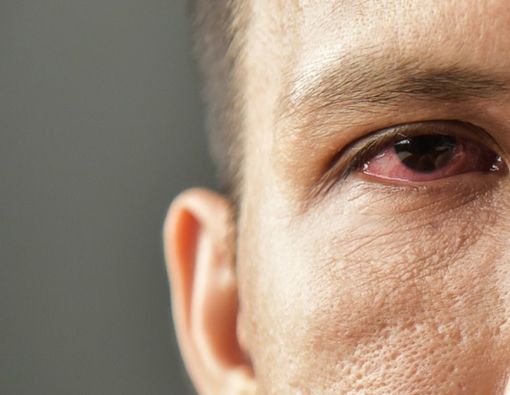 Long COVID-19 Bisa Dideteksi Lewat Kerusakan Kornea Mata