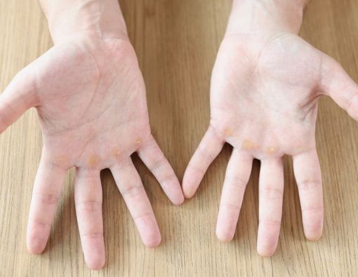 Muncul Mata Ikan di Tangan? Kenali Penyebab dan Cara Mengatasinya