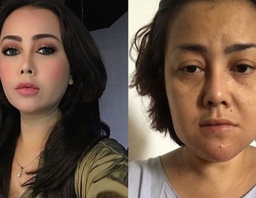Suntik Filler, Rency Milano Alami Pembengkakan dan Bernanah di Wajah!
