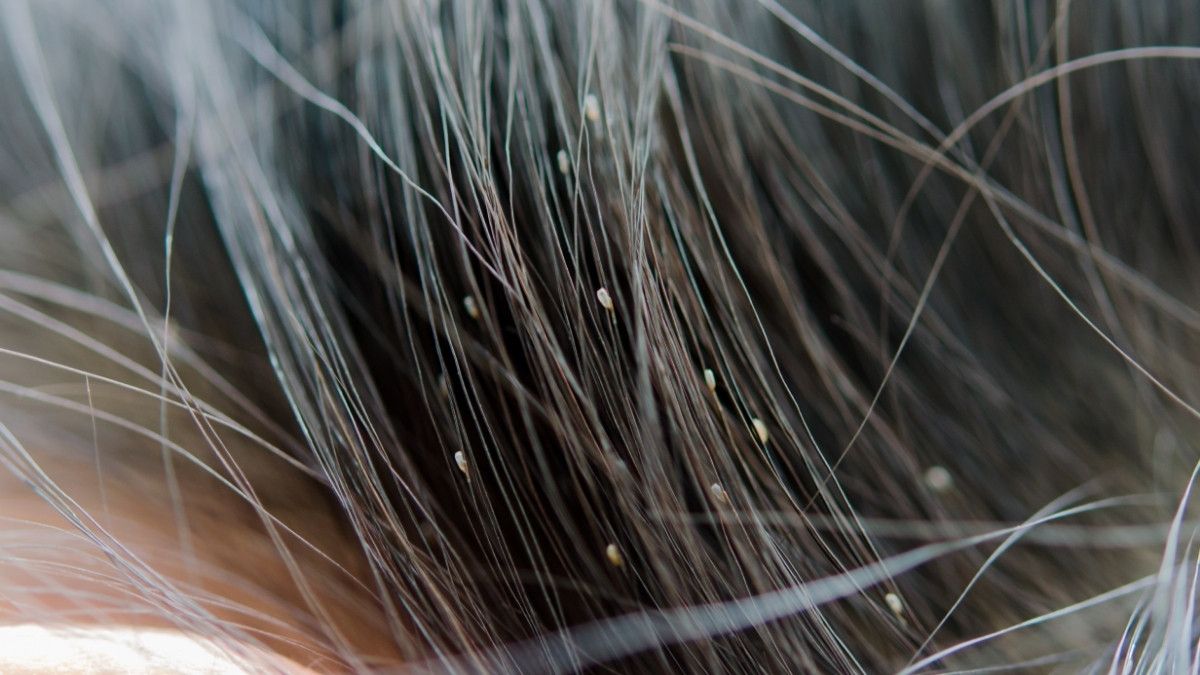 Cara Mudah Singkirkan Kutu Rambut