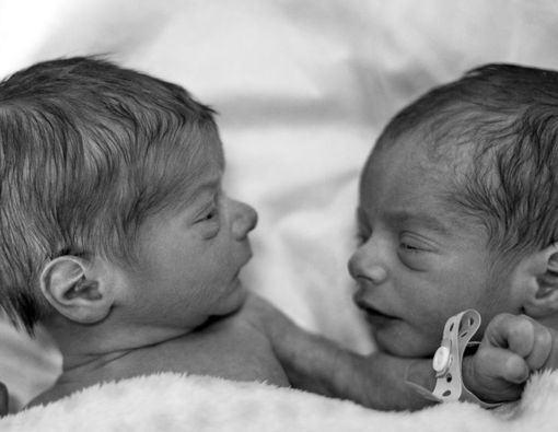 Punya Anak Kembar, Waspada Twin Anemia Polycythemia Sequence